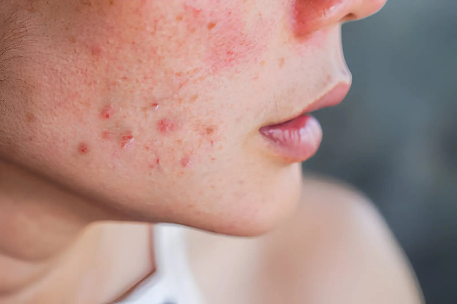 How to Treat Acne and Blemishes Effectively Skinarchives