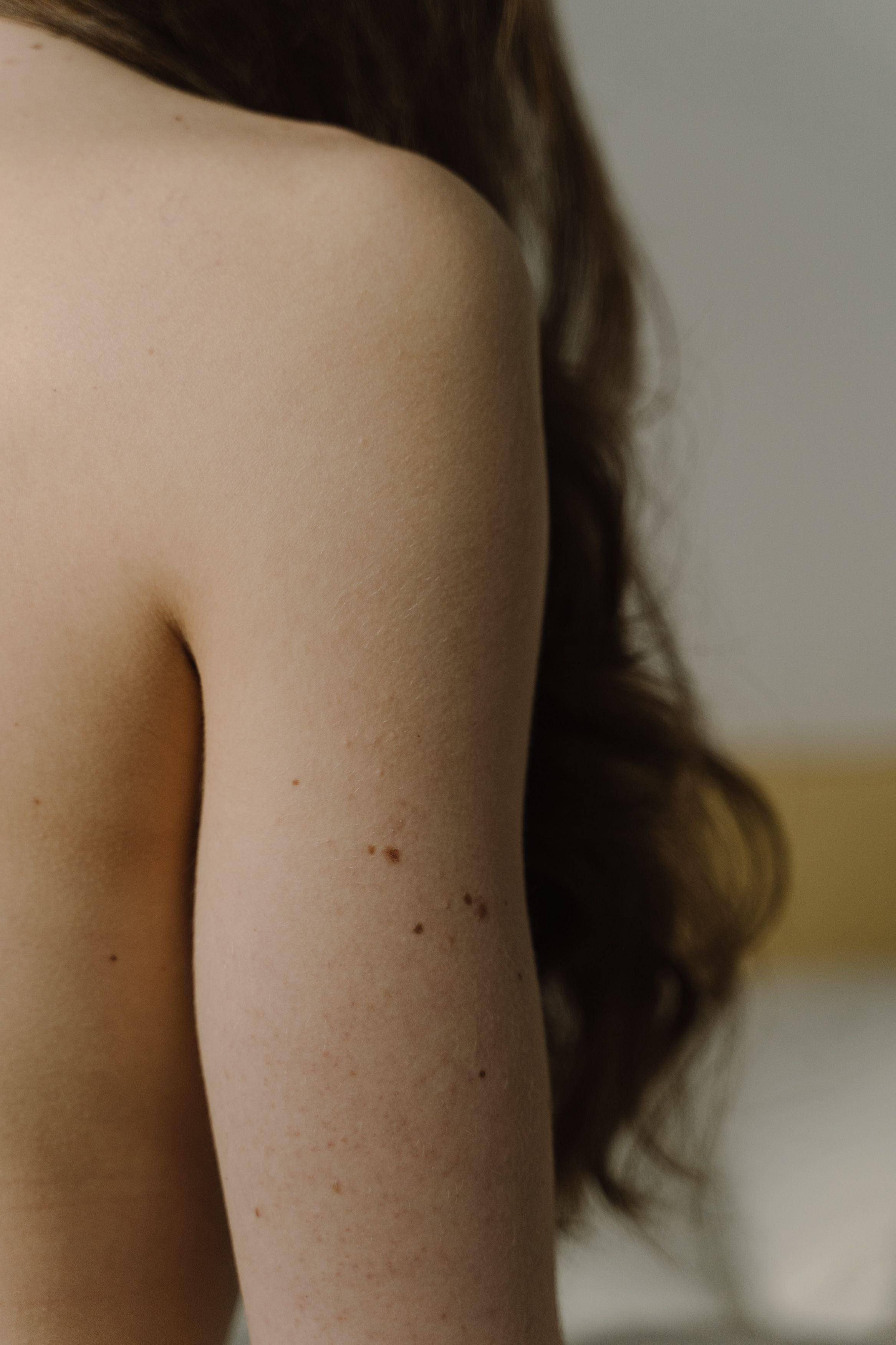 Keratosis Pilaris