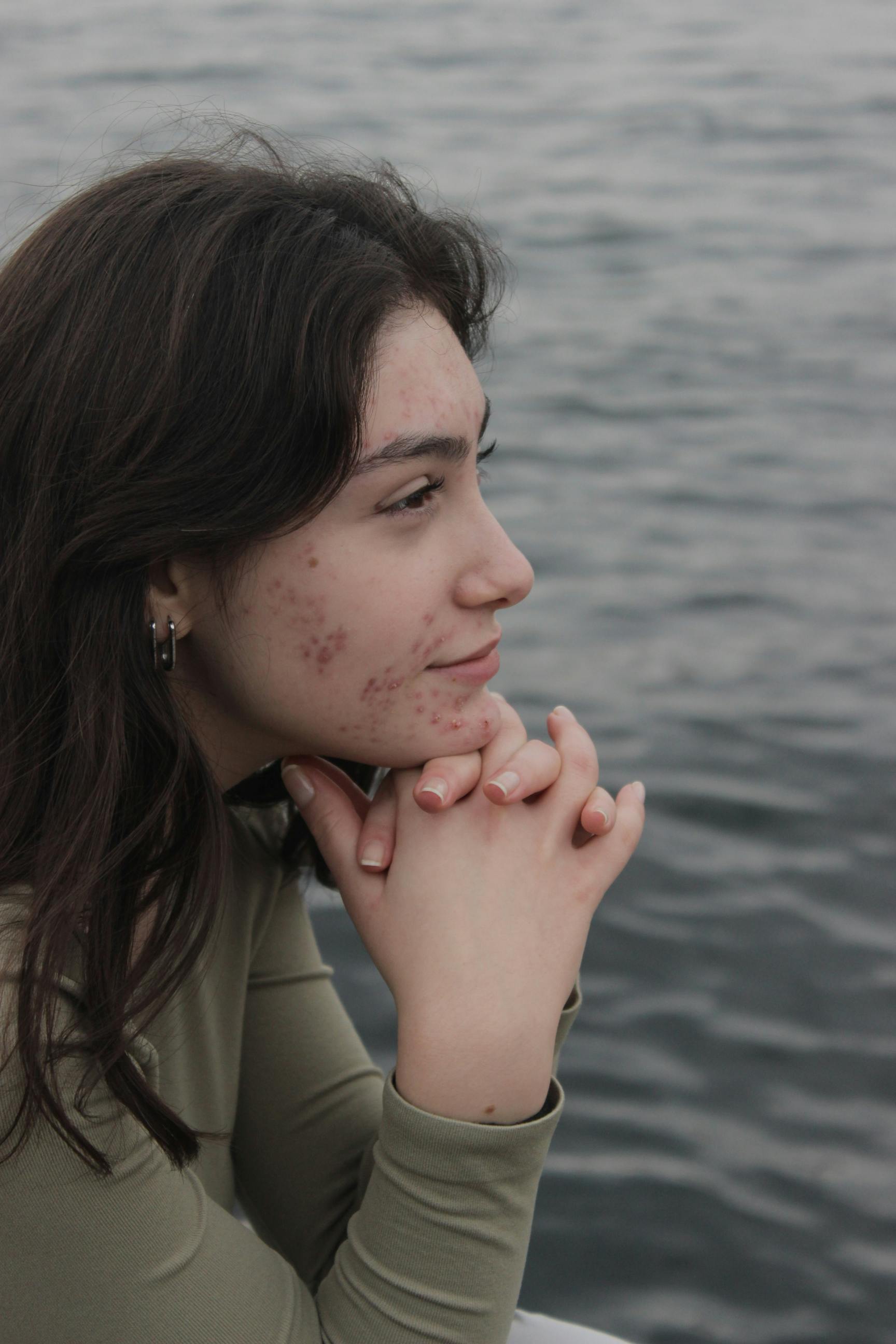 Acne & Blemishes